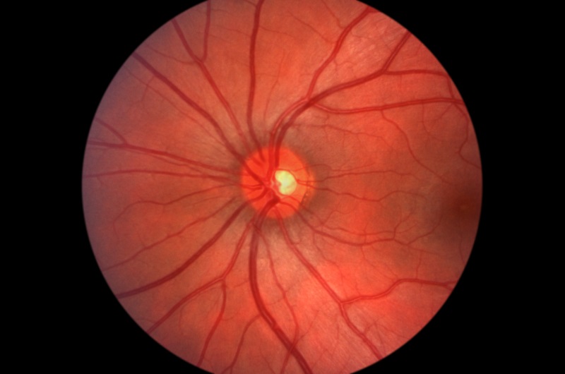 Glaucoma peoria az